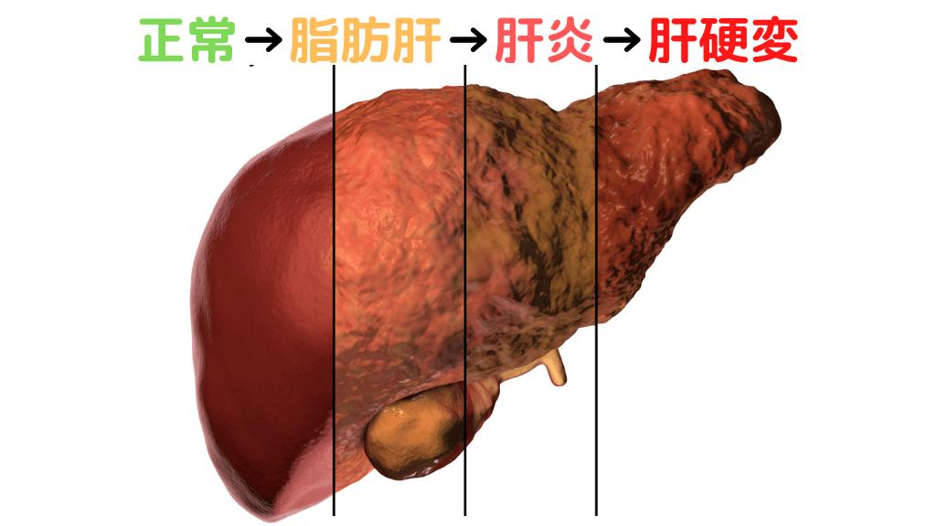 アルコール肝障害の見た目の変化 正常肝→脂肪肝→肝炎→肝硬変（肝癌）