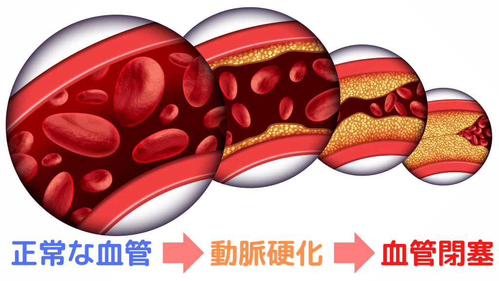正常な血管から動脈硬化が進行して血管が閉塞するまでの流れ